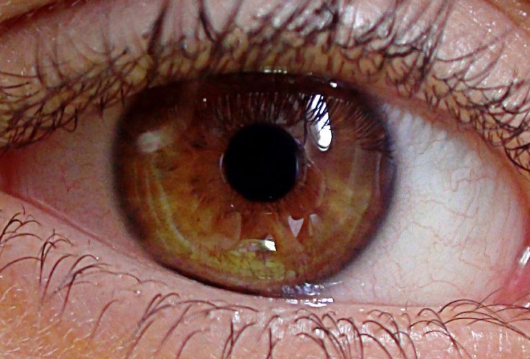 First transplant of reprogrammed stem cells from another person