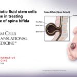 Human amniotic fluid stem cells show promise in treating severest type of spina bifida Human amniotic fluid stem cells show promise in treating severest type of spina bifida