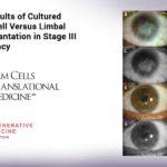 Study shows stem cells may be better choice than tissue transplantation for treating LSCD Study shows stem cells may be better choice than tissue transplantation for treating LSCD