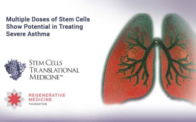 Multiple Doses of Stem Cells Show Potential in Treating Severe Asthma