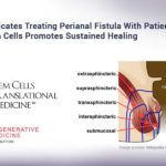 Study Indicates Treating Perianal Fistula With Patient’s Own Stem Cells Promotes Sustained Healing