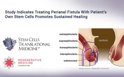 Study Indicates Treating Perianal Fistula With Patient’s Own Stem Cells Promotes Sustained Healing