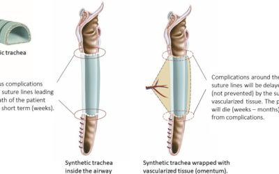 Commentary: The sobering truth about tracheal regeneration