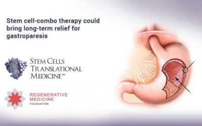 Stem cell-combo therapy could bring long-term relief for gastroparesis