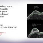 Adipose-derived stem cells significantly improve fat graft retention in breast augmentation Adipose-derived stem cells significantly improve fat graft retention in breast augmentation