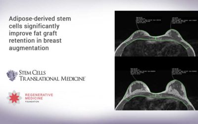 Adipose-derived stem cells significantly improve fat graft retention in breast augmentation