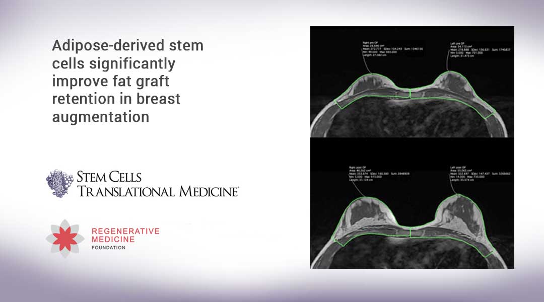Adipose-derived stem cells significantly improve fat graft retention in breast augmentation