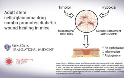 Adult stem cells/glaucoma drug combo promotes diabetic wound healing in mice