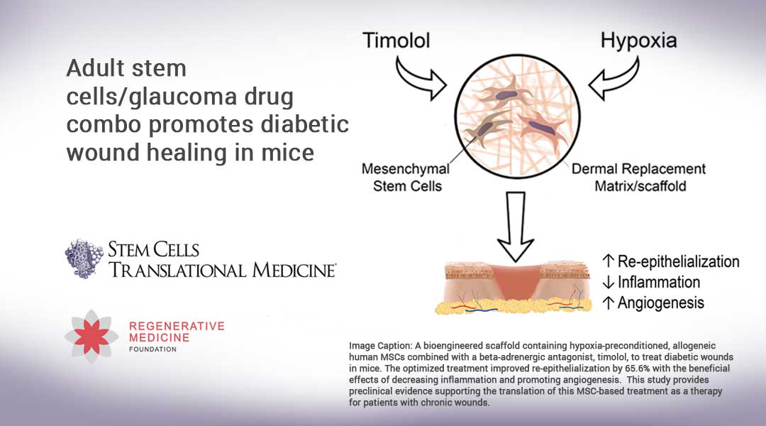 Adult stem cells/glaucoma drug combo promotes diabetic wound healing in mice