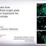 Study shows how amniotic fluid might yield new, better treatment for ischemic stroke Study shows how amniotic fluid might yield new, better treatment for ischemic stroke