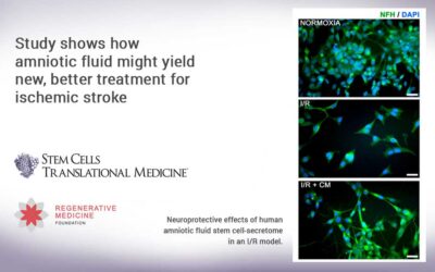 Study shows how amniotic fluid might yield new, better treatment for ischemic stroke