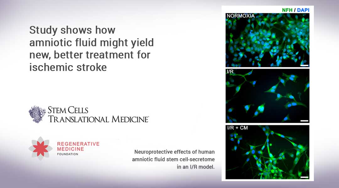 Study shows how amniotic fluid might yield new, better treatment for ischemic stroke