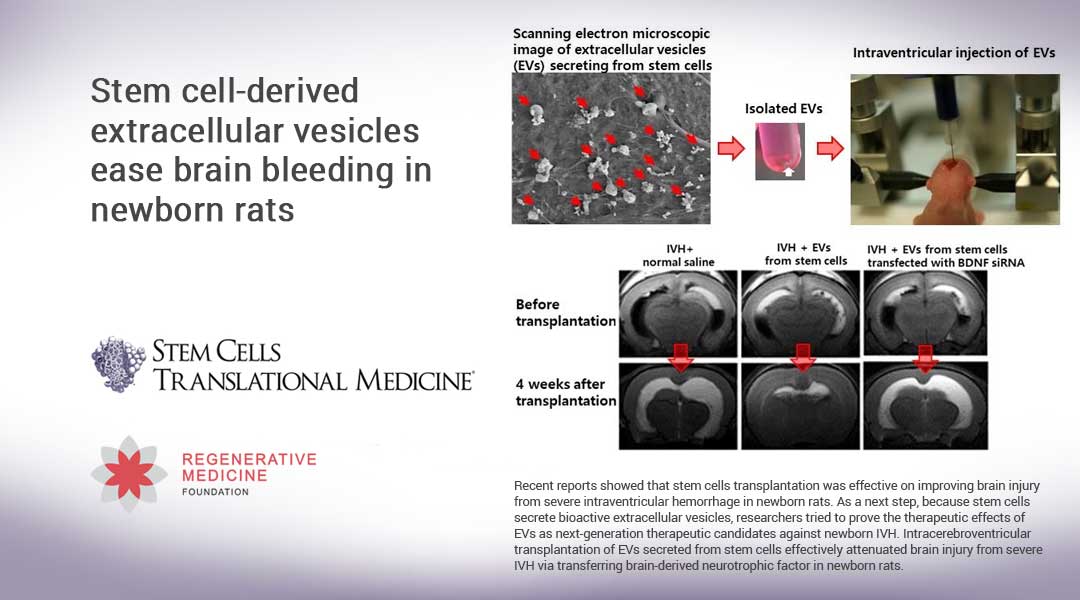 Stem cell-derived extracellular vesicles ease brain bleeding in newborn rats