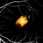 Retinal cell transplant clears experimental hurdle toward treating blindness