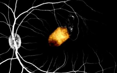 Retinal cell transplant clears experimental hurdle toward treating blindness