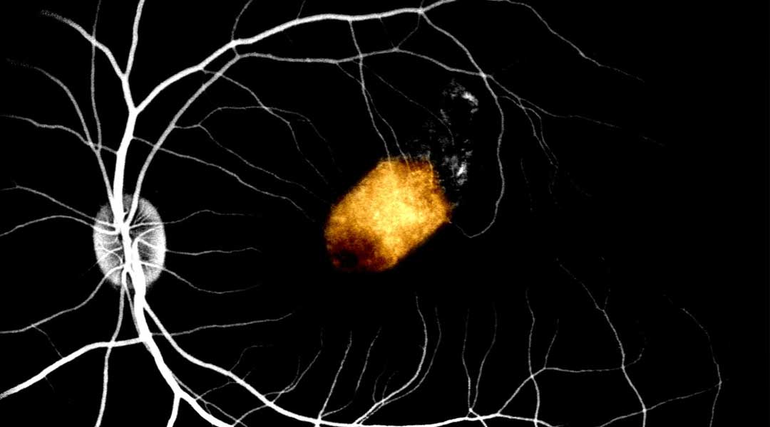 This is an image of RPE implant embedded in the sub-retinal space of a non-human primate model. The background retinal vessels highlighted by fundus fluorescein angiography.