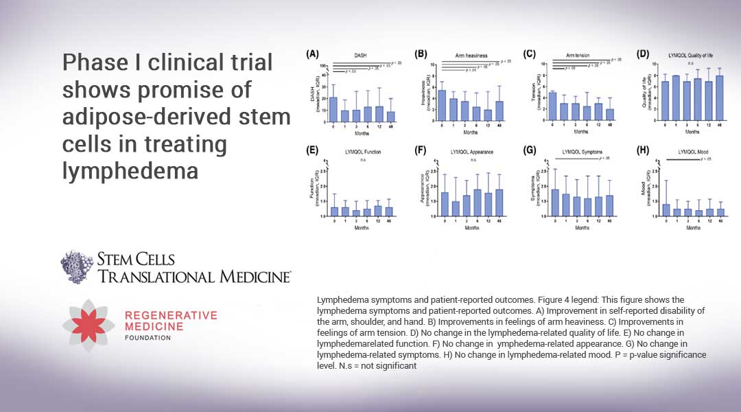 Phase I clinical trial shows promise of adipose-derived stem cells in treating lymphedema