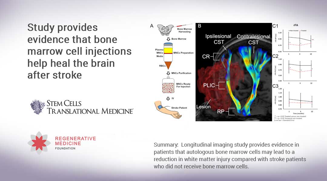 Study provides evidence that bone marrow cell injections help heal the brain after stroke