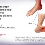 Stem cell therapy research could help patients with non-healing diabetic foot ulcers