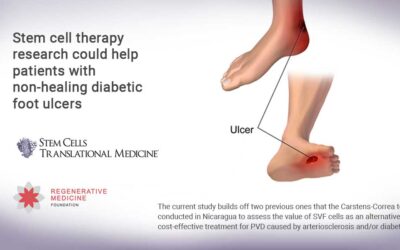 Stem cell therapy research could help patients with non-healing diabetic foot ulcers