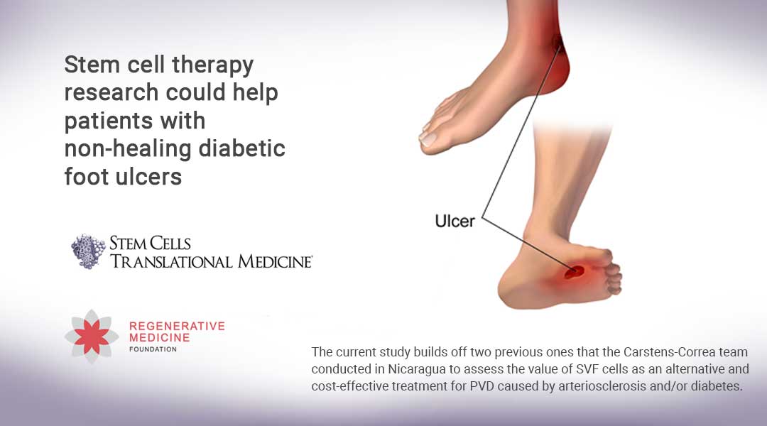 Stem cell therapy research could help patients with non-healing diabetic foot ulcers