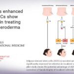 Fat grafts enhanced with ADSCs show promise in treating facial scleroderma Fat grafts enhanced with ADSCs show promise in treating facial scleroderma