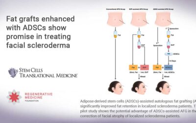 Fat grafts enhanced with ADSCs show promise in treating facial scleroderma