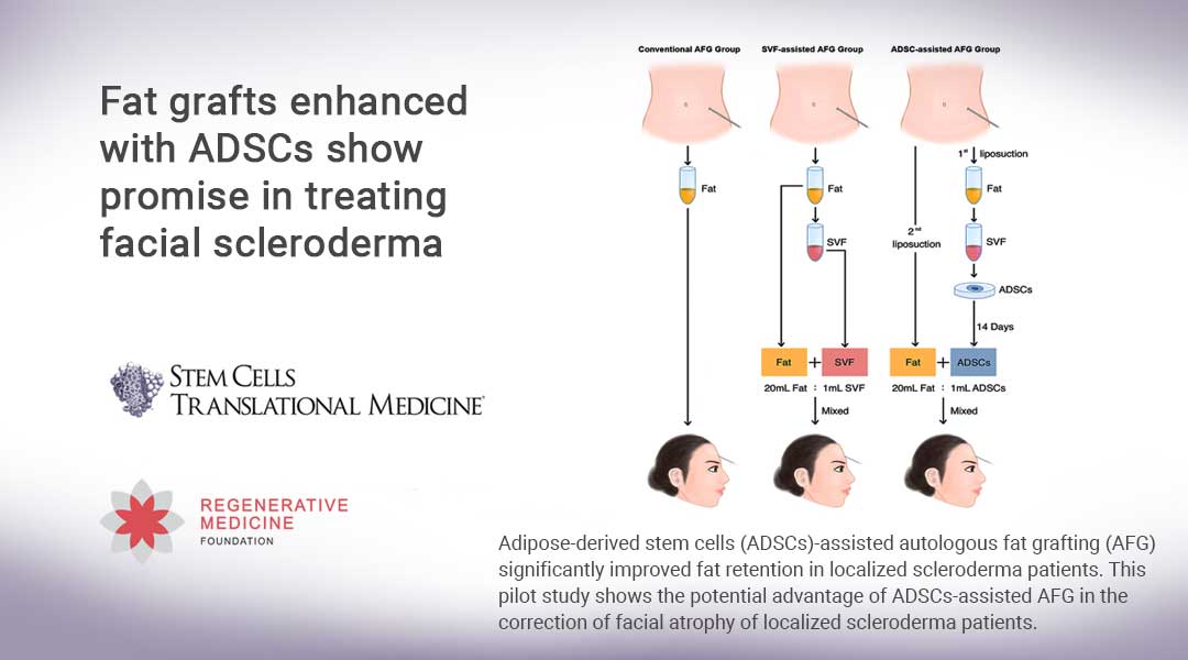 Fat grafts enhanced with ADSCs show promise in treating facial scleroderma