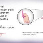 Clinical trial assesses stem cells’ ability to prevent major cause of preemie deaths Clinical trial assesses stem cells’ ability to prevent major cause of preemie deaths