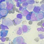 Patient with leukemia, virus infection cured post stem transplant Patient with leukemia, virus infection cured post stem transplant