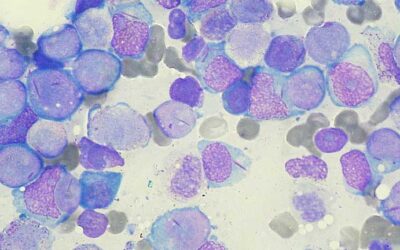 Patient with leukemia, virus infection cured post stem transplant