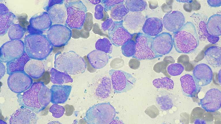 Patient with leukemia, virus infection cured post stem transplant