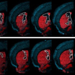 Converting brain immune cells into neurons helps mice recover after stroke Converting brain immune cells into neurons helps mice recover after stroke